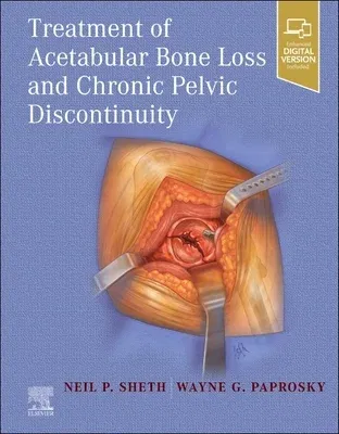 Treatment of Acetabular Bone Loss and Chronic Pelvic Discontinuity