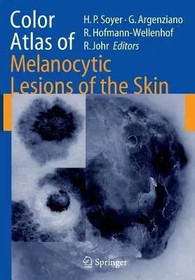 Color Atlas of Melanocytic Lesions of the Skin